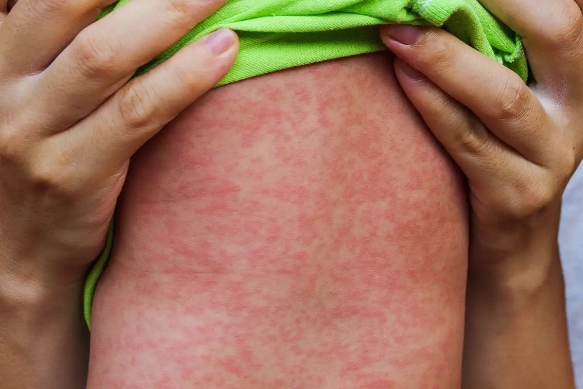 Mazelenbabykindziektevaccinatie MR