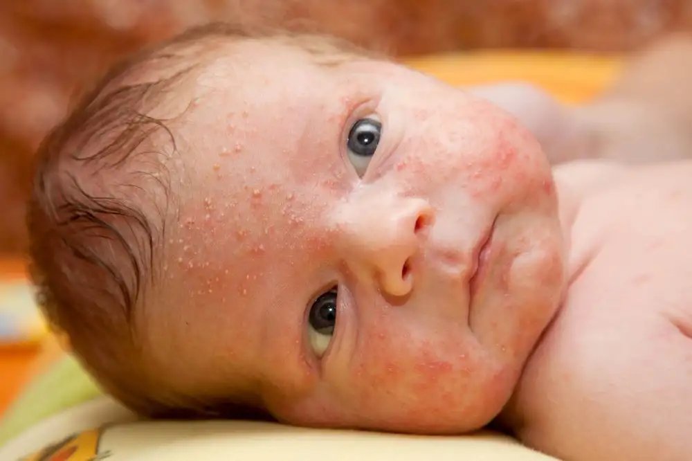 Baby acne puistjes
