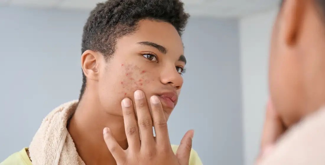 Puistjes en acne puber